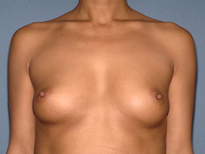 Breast Implants - Breast Augmentation Before & After Patient #4276
