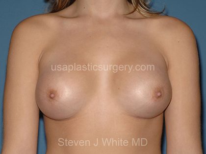 Breast Implants - Breast Augmentation Before & After Patient #4215