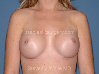 Breast Implants - Breast Augmentation Before & After Patient #4211