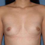 Breast Implants - Breast Augmentation Before & After Patient #4210