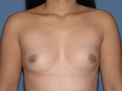 Breast Implants - Breast Augmentation Before & After Patient #4210