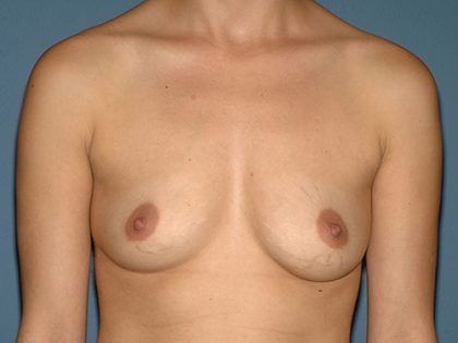 Breast Implants - Breast Augmentation Before & After Patient #4209