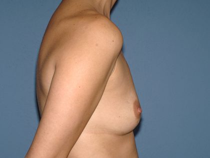Breast Implants - Breast Augmentation Before & After Patient #4209