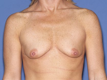 Breast Implants - Breast Augmentation Before & After Patient #4208