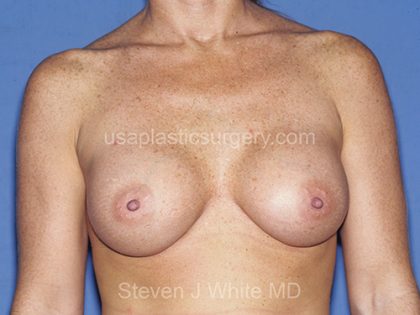 Breast Implants - Breast Augmentation Before & After Patient #4208