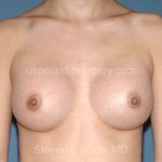 Breast Implants - Breast Augmentation Before & After Patient #1886