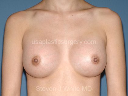 Breast Implants - Breast Augmentation Before & After Patient #1886