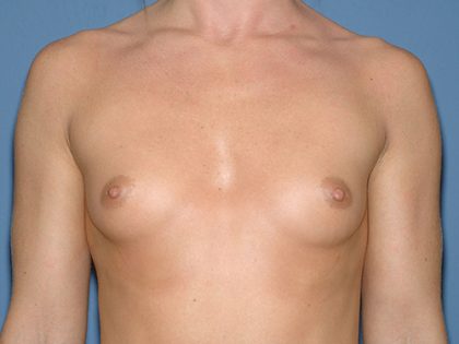 Breast Implants - Breast Augmentation Before & After Patient #4131