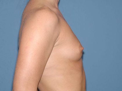 Breast Implants - Breast Augmentation Before & After Patient #4131