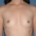 Breast Implants - Breast Augmentation Before & After Patient #4133