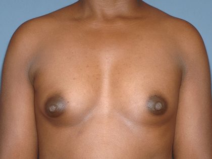 Breast Implants - Breast Augmentation Before & After Patient #4134