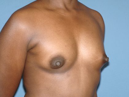 Breast Implants - Breast Augmentation Before & After Patient #4134