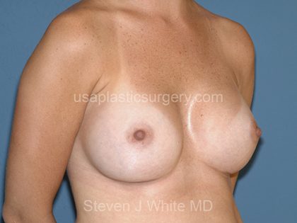 Breast Implants - Breast Augmentation Before & After Patient #4135