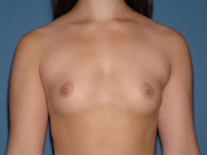 Breast Implants - Breast Augmentation Before & After Patient #4138