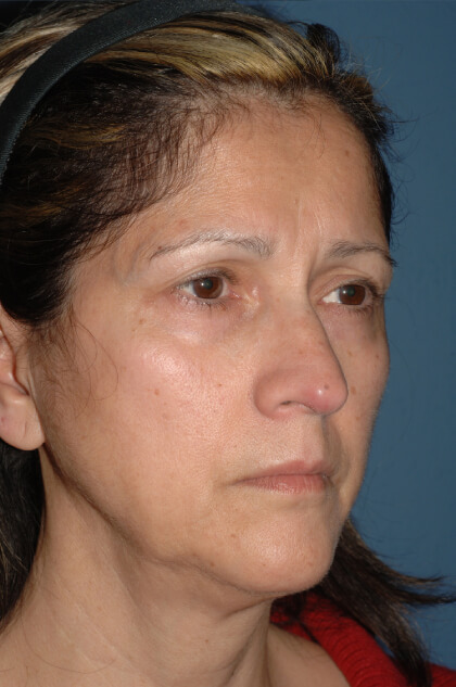 Upper & Lower Facelift – Brow Lift & Face/Neck Lift Before & After Patient #2638