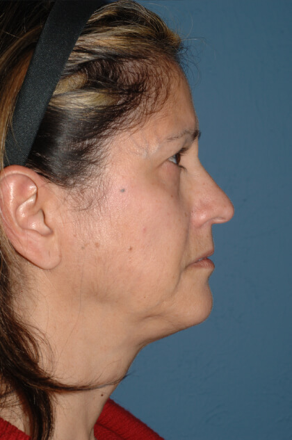 Upper & Lower Facelift – Brow Lift & Face/Neck Lift Before & After Patient #2638