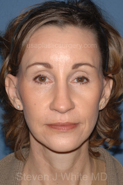 Upper & Lower Facelift – Brow Lift & Face/Neck Lift Before & After Patient #2639