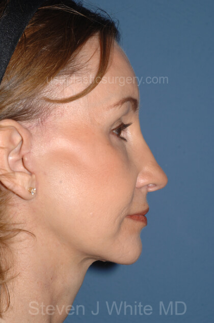 Upper & Lower Facelift – Brow Lift & Face/Neck Lift Before & After Patient #2639