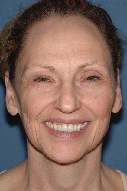 Upper & Lower Facelift – Brow Lift & Face/Neck Lift Before & After Patient #2640