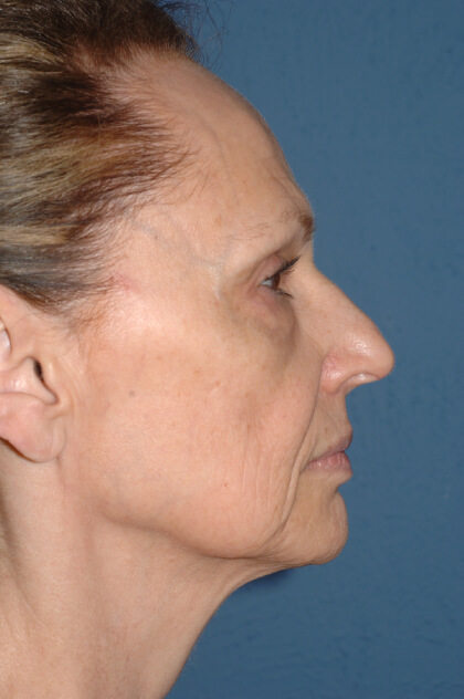 Upper & Lower Facelift – Brow Lift & Face/Neck Lift Before & After Patient #2640