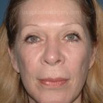Upper & Lower Facelift – Brow Lift & Face/Neck Lift Before & After Patient #2641