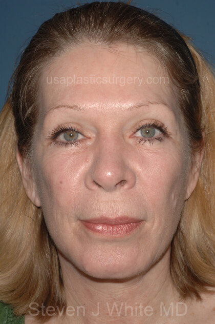 Upper & Lower Facelift – Brow Lift & Face/Neck Lift Before & After Patient #2641