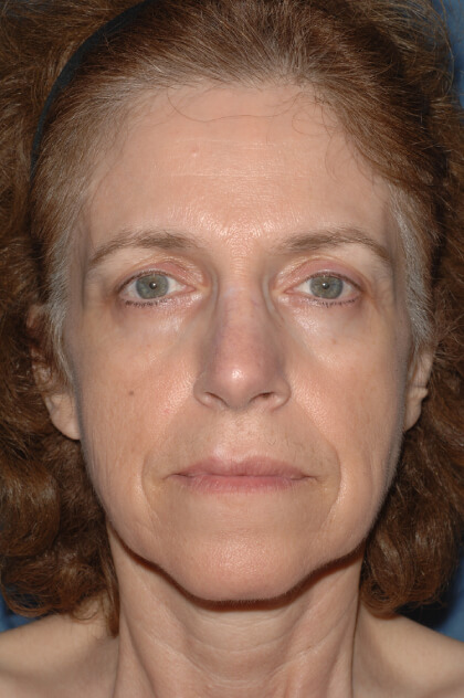 Upper & Lower Facelift – Brow Lift & Face/Neck Lift Before & After Patient #2642