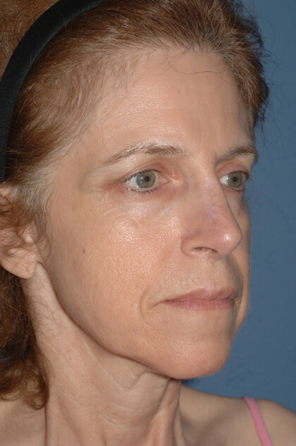 Upper & Lower Facelift – Brow Lift & Face/Neck Lift Before & After Patient #2642