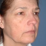 Upper & Lower Facelift – Brow Lift & Face/Neck Lift Before & After Patient #2643