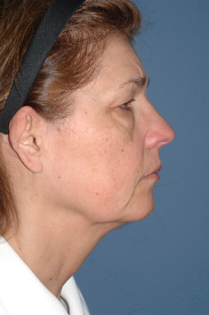 Upper & Lower Facelift – Brow Lift & Face/Neck Lift Before & After Patient #2643