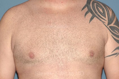 Male Breast Reduction - Gynecomastia Before & After Patient #2285