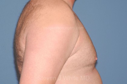 Male Breast Reduction - Gynecomastia Before & After Patient #2285