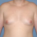 Male Breast Reduction - Gynecomastia Before & After Patient #2294