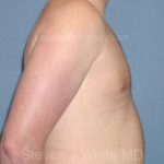 Male Breast Reduction - Gynecomastia Before & After Patient #2294