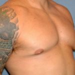 Male Breast Reduction - Gynecomastia Before & After Patient #2355