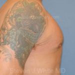 Male Breast Reduction - Gynecomastia Before & After Patient #2355