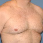 Male Breast Reduction - Gynecomastia Before & After Patient #2356