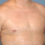 Male Breast Reduction - Gynecomastia Before & After Patient #2356