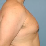 Male Breast Reduction - Gynecomastia Before & After Patient #2357