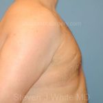 Male Breast Reduction - Gynecomastia Before & After Patient #2357
