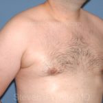 Male Breast Reduction - Gynecomastia Before & After Patient #2358