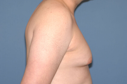 Male Breast Reduction - Gynecomastia Before & After Patient #2358