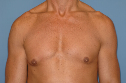 Male Breast Reduction - Gynecomastia Before & After Patient #2359