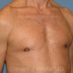 Male Breast Reduction - Gynecomastia Before & After Patient #2359