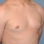Male Breast Reduction - Gynecomastia Before & After Patient #2360