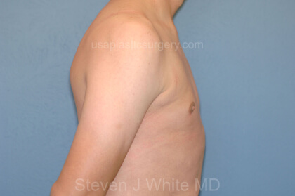Male Breast Reduction - Gynecomastia Before & After Patient #2360