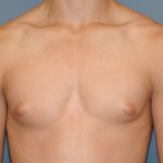 Male Breast Reduction - Gynecomastia Before & After Patient #2361