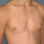 Male Breast Reduction - Gynecomastia Before & After Patient #2361