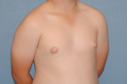 Male Breast Reduction - Gynecomastia Before & After Patient #2362