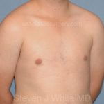 Male Breast Reduction - Gynecomastia Before & After Patient #2362
